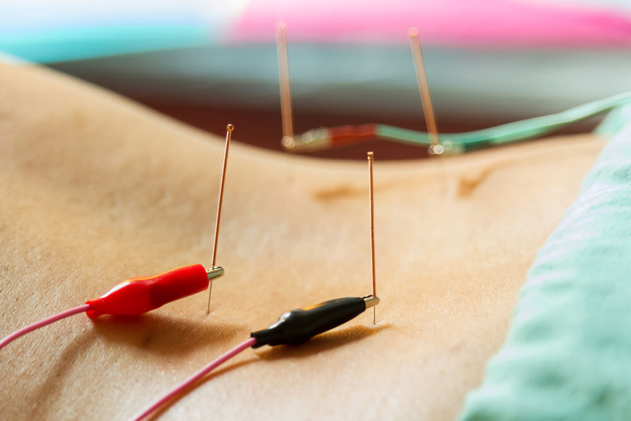 Electro-acupuncture